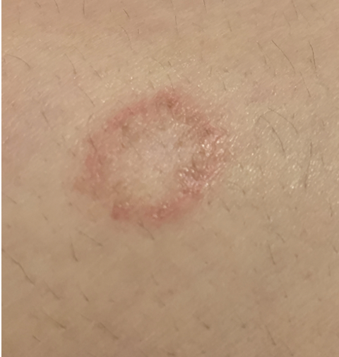 Unknown rash under left boob (pictured) and same kind of rash in my butt  crack what is this? : r/Dermatology