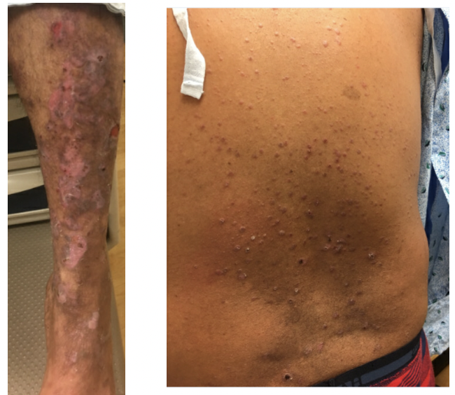 VisualDx - What's the Diagnosis? A 31-year-old woman went to urgent care  complaining of fever and chills lasting a few days, which she originally  thought was the flu. Today she started to