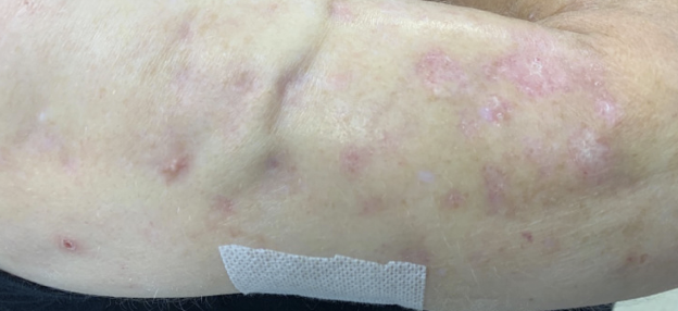 Foto de Medical: Tinea versicolor is a condition caused by the Malassezia  globosa fungus a form of yeasts. It is characterized by a skin discolor  eruption on the trunk and proximal extremities.